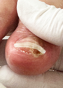 toenail_img_09