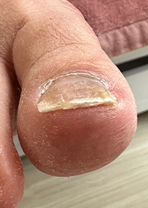 toenail_img_11
