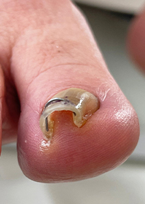 toenail_img_13