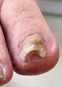 toenail_img_15
