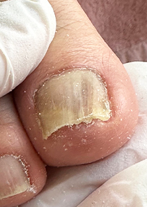 toenail_img_17