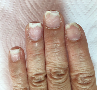 toenail_img_25