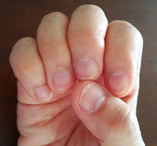 toenail_img_27