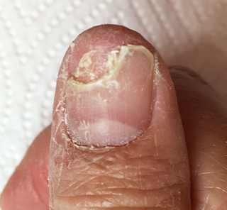toenail_img_29