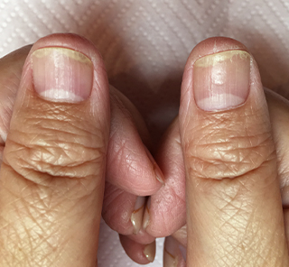 toenail_img_31 toenail_img_31